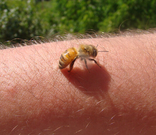 Biene Insekt Stich Arm